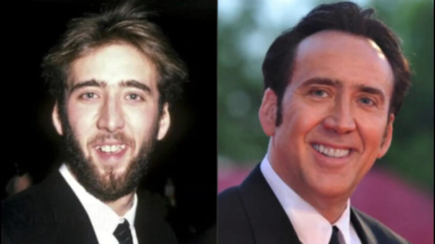 Nicolas Cage teeth before and after